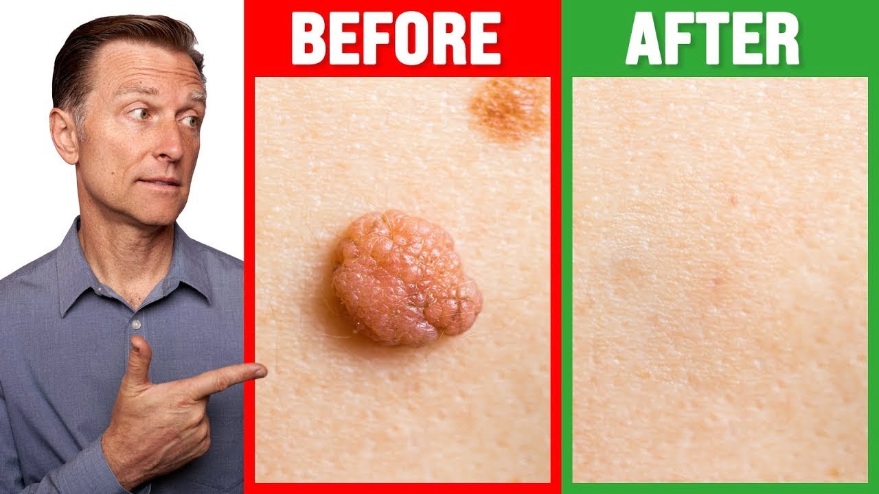 get rid of skin warts